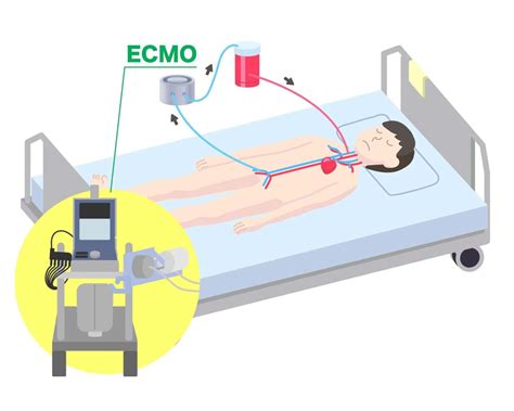 Ecmo Cpt Code 2024 - Cati Mattie