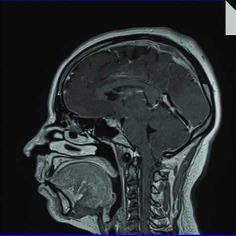 RMN Cerebral En T1 Corte Sagital Con Contraste Donde Se Evidencia