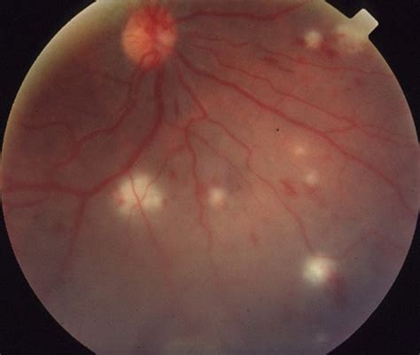 Classification Criteria For Behçet Disease Uveitis American Journal