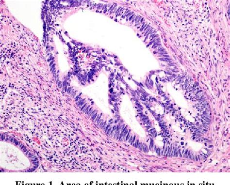 Figure From Intestinal Type In Situ Adenocarcinoma Of The Cervix As A