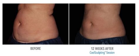 Coolsculpting Elite Fat Reduction Phoenix Az Suddenly Slimmer