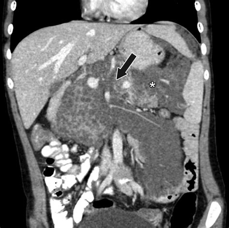 Imaging Features Of Neurofibromatosis Type In The Abdomen And Pelvis