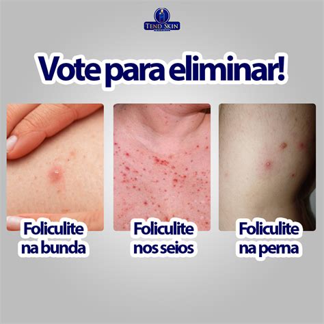 Foliculite Nas Costas Qual O Tratamento Mais Eficaz Dr Foliculite