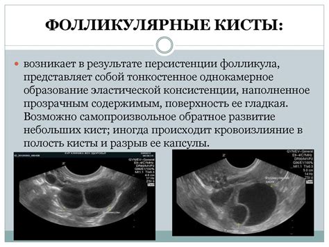 Опухоли яичников - презентация онлайн