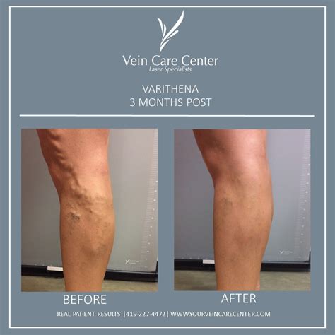 Varithena Before After Lima Ohio Vein Care Center