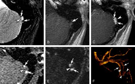 Fig Partially Recanalized Chronic Dural Sinus Thrombosis Findings