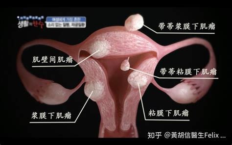 有子宫肌瘤还可以怀孕吗？ 知乎