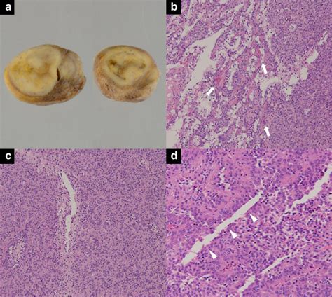 Gross Specimen And Microscopic Findings Of A Lung Nodule A Gross