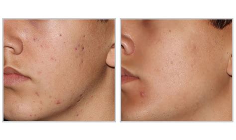 Acne Laser Treatment Vancouver Forever Clear BBL SkinGlow