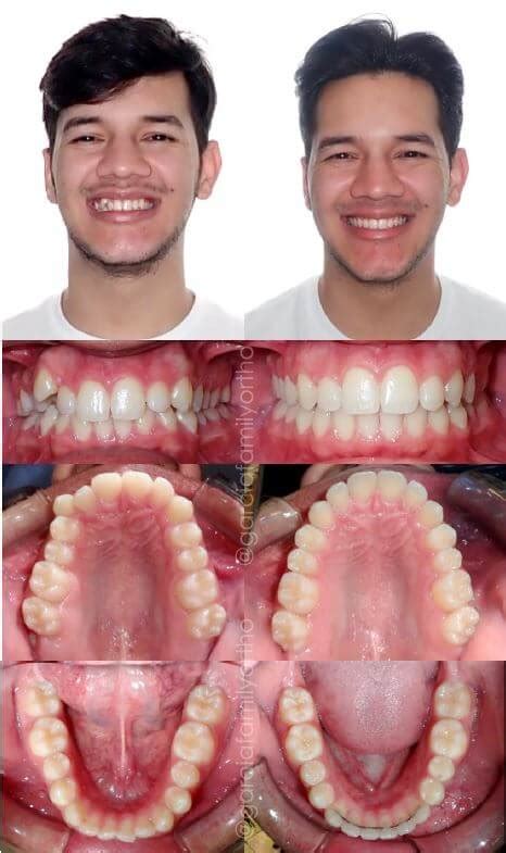 Palate Expander Before And After