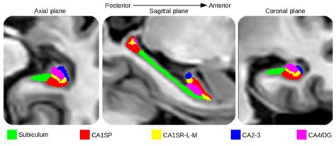 Segmentation Of The Hippocampal Subfields From Left To Right