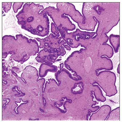 Hyperplastic Polyps Basicmedical Key