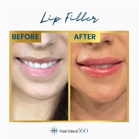 Lip Filler Before And After Feel Ideal 360 Med Spa Southlake Tx