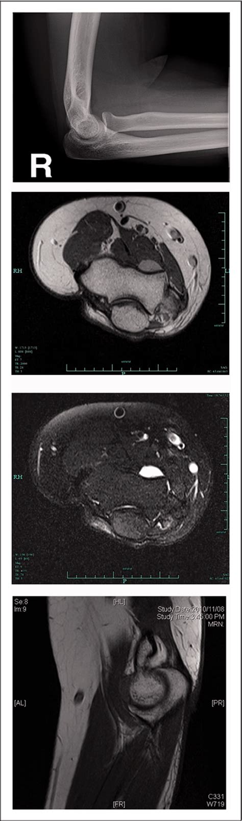 Figure From Synovial Sarcoma Of The Elbow Presenting With Painful