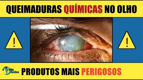 O QUE FAZER APÓS UMA QUEIMADURA NO OLHO dicas para olhos optoensina