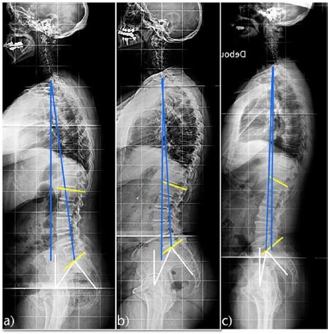 Comparison Of Sagittal Standing Radiographs In A A Patient With Download Scientific Diagram