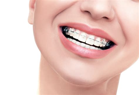 The Pros And Cons Of Ceramic Braces