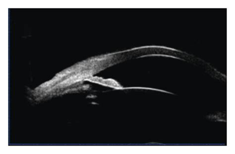 (a) Ultrasound biomicroscopy demonstrating peripheral anterior ...