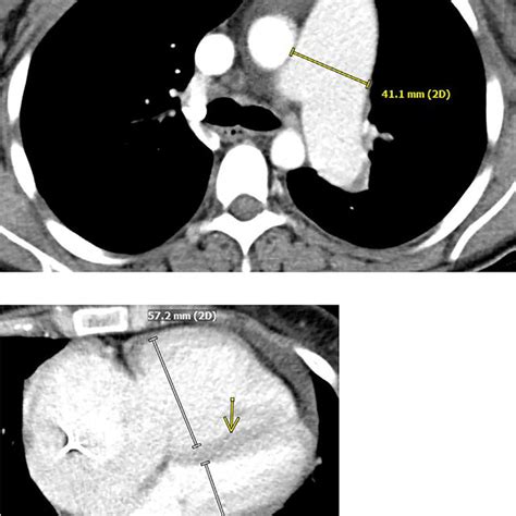 Ct Pulmonary Angiogram A Axial Ct Image At The Level Of The