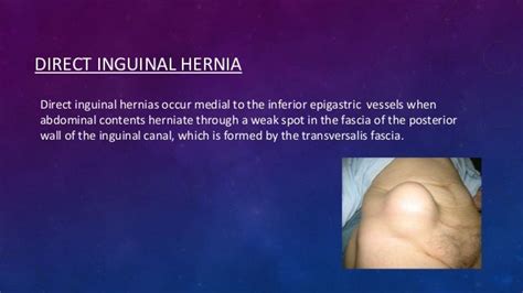 Inguinal Hernia Presentation Images