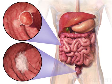 Colorectal cancer - Wikipedia