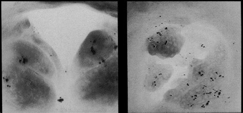 FIGURE Laryngoscopic view of Laryngeal papilloma which resected in ...