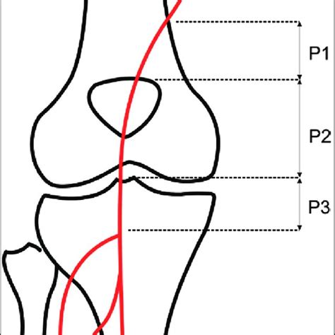 Schematic Representation Of The Segments Of Popliteal Artery P1