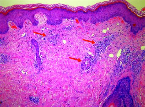 Hematoxylin And Eosin Stained Skin Biopsy Showing Epidermis And Dermis