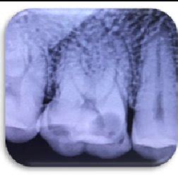 Tracing A Sinus Tract A Gutta Percha B Radiographic Verification