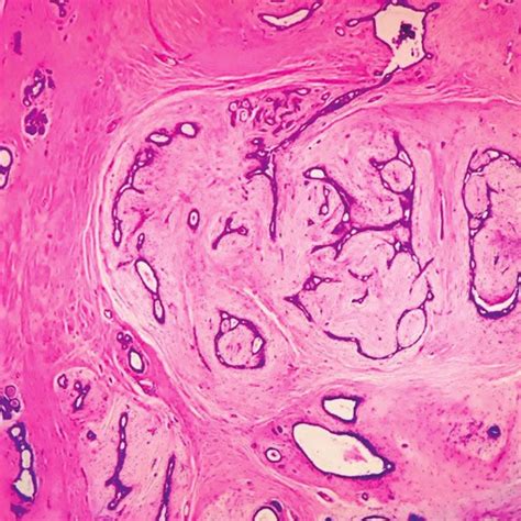 Phyllodes Tumor Showing Tongue Like Protrusion Formed By Stromal