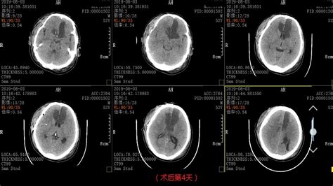 一例重型颅脑损伤患者急诊救治及早期康复治疗体会 颅脑创伤 神经重症病例周刊（138期） 脑医汇 神外资讯 神介资讯