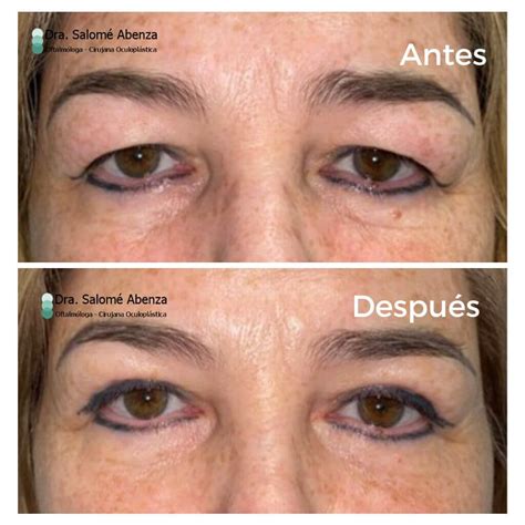 Blefaroplastia Superior Funcional Para Mejorar El Campo Visual