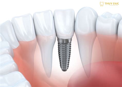 Quy trình trồng răng Implant chuẩn Y khoa