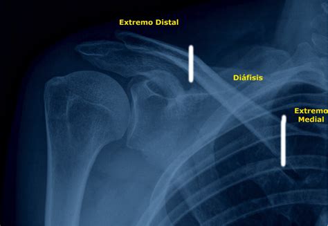 Fractura De Clavícula Guido Fierro