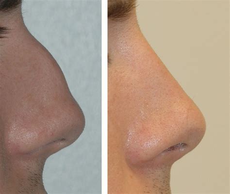 Rhinoplasty Miami Fl Nose Surgery Andres Bustillo Md Facs