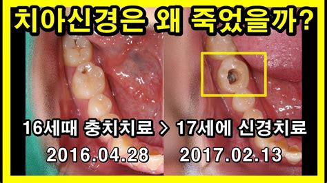 충치치료를 했어도 치아신경은 왜 죽었을까 세균이 아닌 교합구조 시스템 이 중요하다 교합치수염 신경치료03강 Youtube