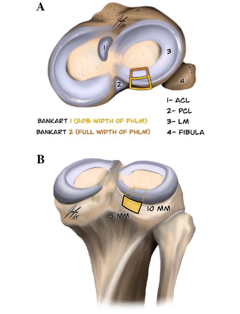 A Axial View Of The Tibial Plateau With 1 Tibial Insertion Of The Download Scientific