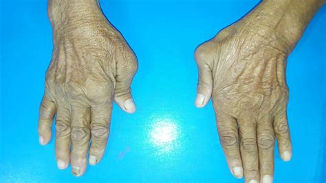Hitchhiker's Thumb Rheumatoid Arthritis at Theresa Dudley blog