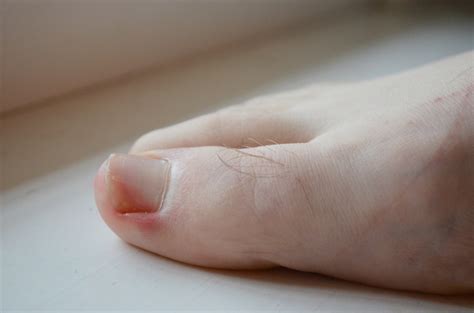 Ingrown Toenail Auckland Auckland Ingrown Toenail Clinic