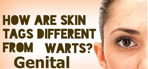 How Are Skin Tags Different From Genital Warts Faculty Of Medicine