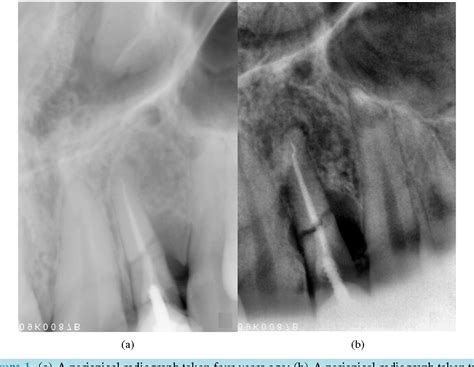 Figure 4 From Alveolar Ridge Preservation Of An Extraction Socket Of Fractured Maxillary Lateral