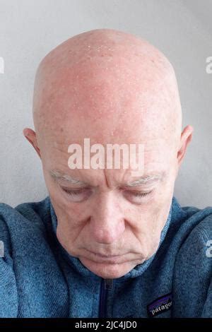 Homme 71 patient tête chauve Visage avec des dommages légers