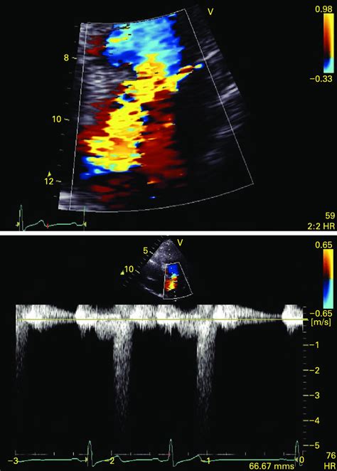 Upper Panel Colour Doppler Image From An Apical Long Axis View Showing