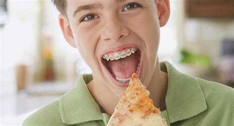 Foods To Avoid With Braces Australia Keenan Sheffield