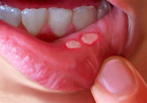 The Causes And Treatment Of Mouth Ulcers A Comprehensive Guide Archyde