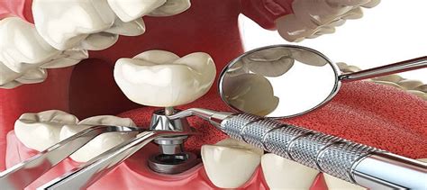 Is Dental Implant Procedure Painful