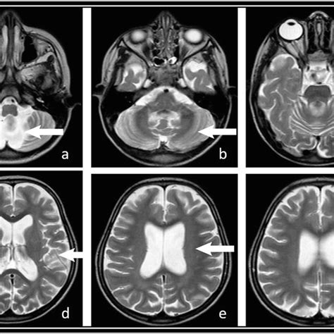 A Patient 1 E T2 Weighted Axial Sections From An Mri Scan Taken 1 Year