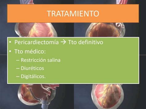 Pericarditis Pericarditis Aguda Derrame Peric Rdico Taponamiento