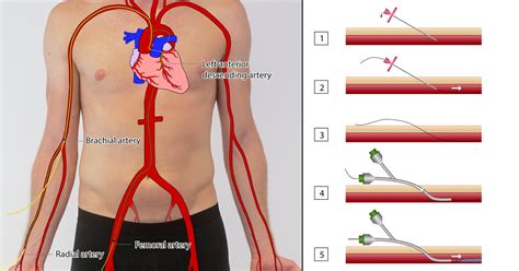 Femoral Artery Cabg