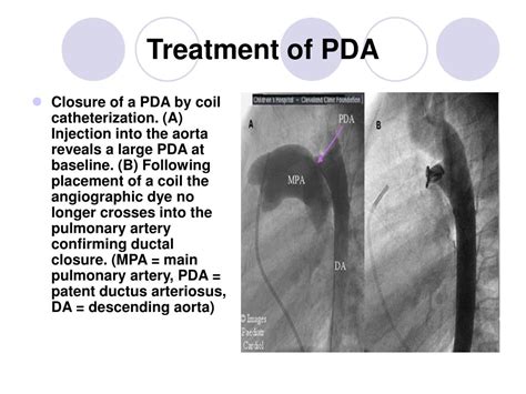 Ppt Patent Ductus Arteriosus Powerpoint Presentation Free Download